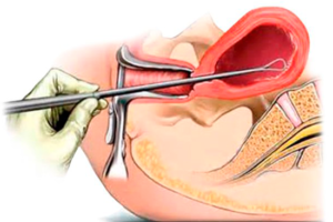 Биопсия эндометрия и беременность