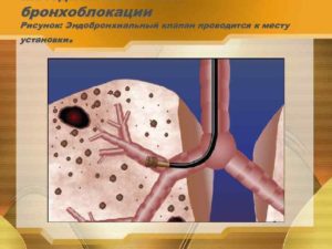 Последствие бронхоблокатора