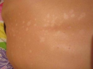 Появились белые пятна на теле