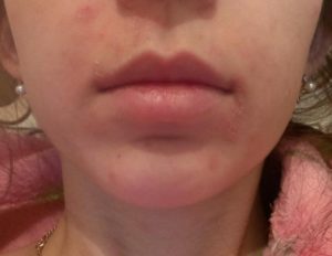 Красные пятна вокруг рта