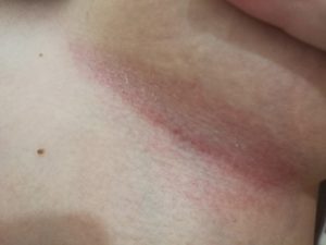 Зуд подмышками и в паху