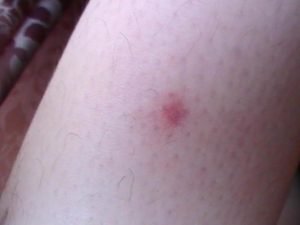 Болезненные шишки после укуса клеща