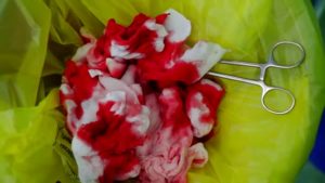 Прием Визанны и кровотечения