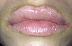 После увеличения губ появились точки