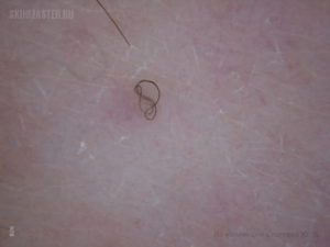 Уплотнение под кожей возле головки