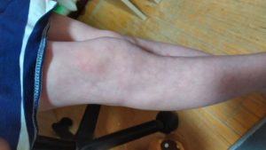 Просвечивают вены на ногах