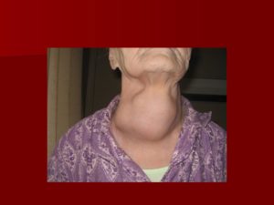 Рак 4 стадия одышка и отеки