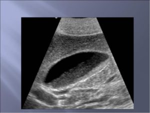 Холецистит, застой желчи, сладж в пузыре