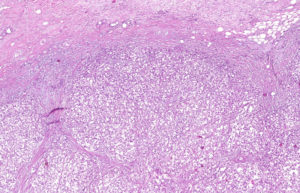 Карцинома G2