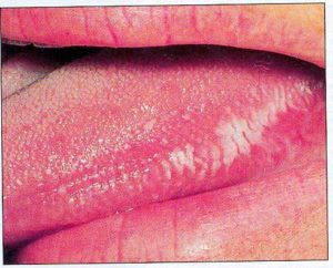 Лейкоплакия полости рта