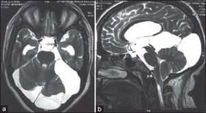 Арахноидальные изменения ликворокистозного характера