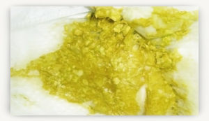 Кислый запах кала у ребенка