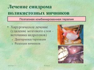 Поликистоз яичников. Как лечить?