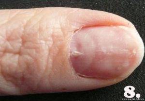 Перепилили ноготь до мяса около кутикулы образовалась дырка