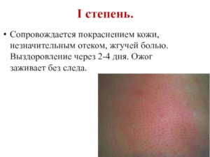 Ожог зажил, но болит