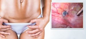 Операция по удалению матки болит низ живота после физической нагрузки