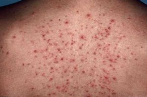 Прыщи и сыпь на спине после массажа