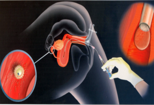 Вероятность забеременеть если сперма попала только на половые губы