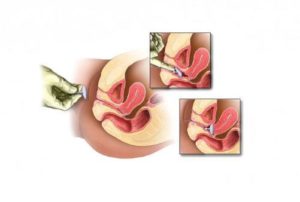 Сужается ли влагалище при отсутствии секса