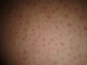 Прыщи на ягодицах чешутся