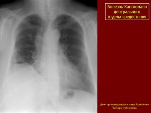 Болезнь Кастлемана