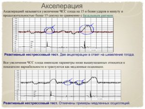 Расшифровка КТГ 8 баллов, много акцелираций и присутствуют децелерации