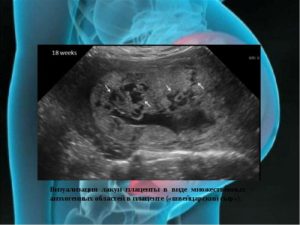 Плацента на передней стенке. Расширение МВП. Анэхогенная структура