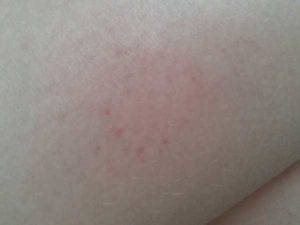 Пятна после электрофореза