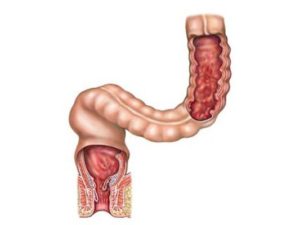 Проктосигмоидит