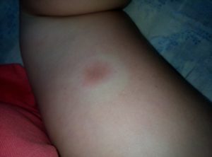 Опухла, покраснела, чешится и болит рука