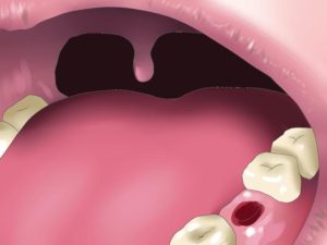 Альвеолит лунки после удаления зуба