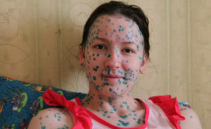 Алкоголь при ветрянке на 12 день