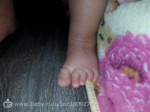 Беспокойный ребенок 1 год, поджимает пальчики на ногах