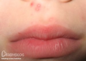 Прыщи возле носа у ребенка