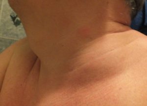 Припухлость в области надключичной ямки