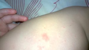 Высыпание на коже при перегибе желчного пузыря