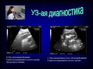 Симптом поражения полого органа