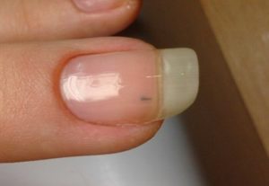 На ногтях черные полоски