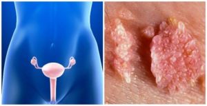 Зуд во влагалище и области ануса