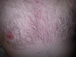 Красное пятно на груди у женщины