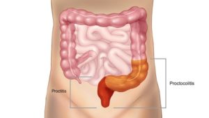 Проктосигмоидит