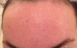 Помогите! Лицо обсыпало прыщами