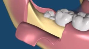 Острый край после удаления