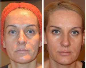 Сколько процедур ЛИТ потребуется