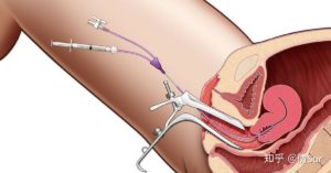 Биопсия эндометрия и беременность