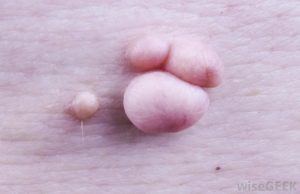 Нарост около анального размера немаленького размера