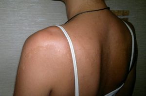 Пятна после электрофореза