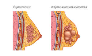 Клайра при фиброзно кистозной мастопатии