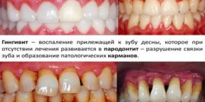 Температура, воспаление дёсен, слабость