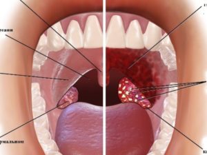 На миндалине появилось белое пятно